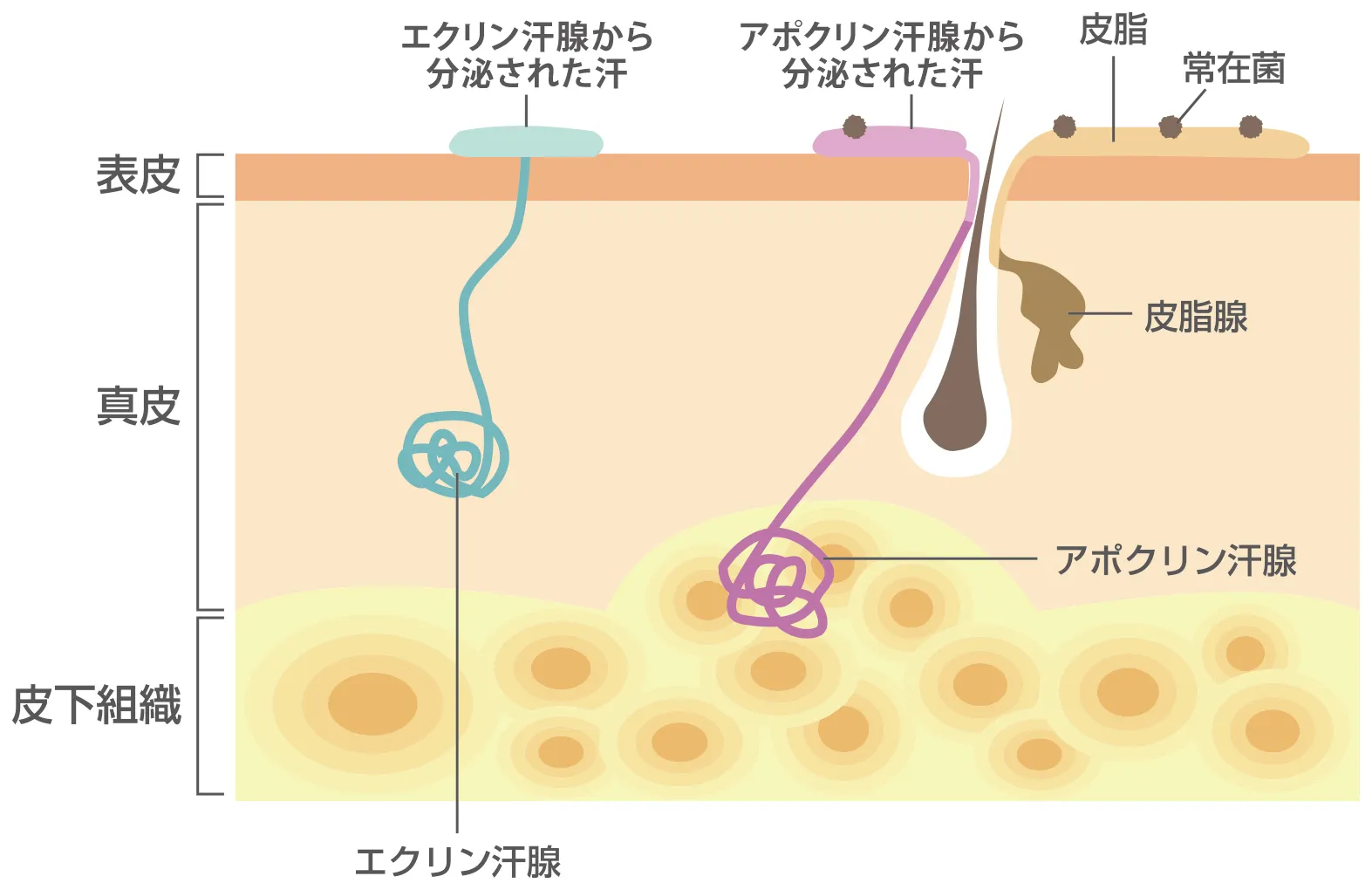 ワキ汗（多汗症）とワキガ（腋臭症）の治療アプローチの違い。多汗症はエクリン汗腺がターゲットで、ボツリヌストキシン注射や塩化アルミニウム（制汗剤）で汗の量を減らす。ワキガはアポクリン汗腺がターゲットで、剪除法で腺自体を除去する。